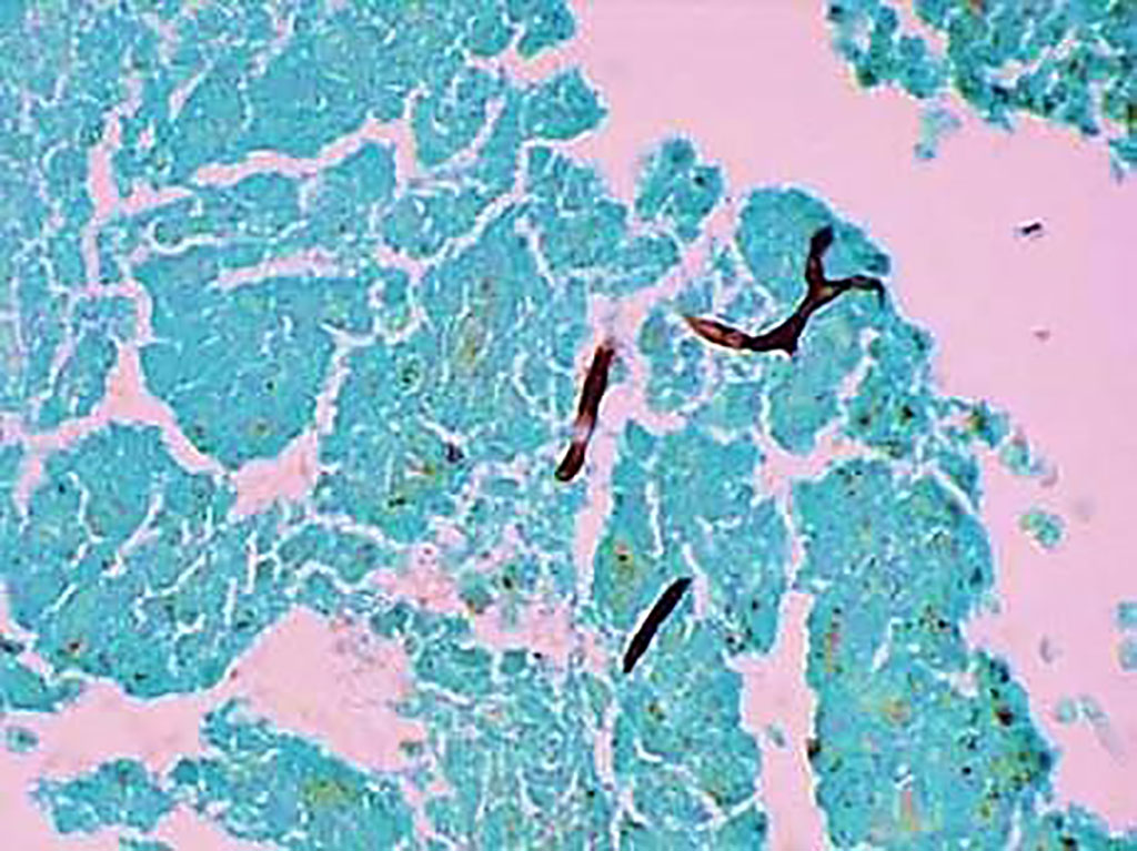 Image: Histopathology of Allergic bronchopulmonary aspergillosis. Grocott\'s Methenamine Silver Stain  shows branching and helps to confirm that the black structures are indeed fungal hyphae (Photo courtesy of Doctorlib)