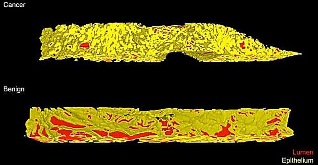 Image: A screenshot of a volume rendering of glands in two 3D biopsy samples from prostates (yellow: the outer walls of the gland; red: the fluid-filled space inside the gland). The cancer sample (top) shows smaller and more densely packed glands compared to the benign tissue sample (bottom) (Photo courtesy of Xie et al./Cancer Research)