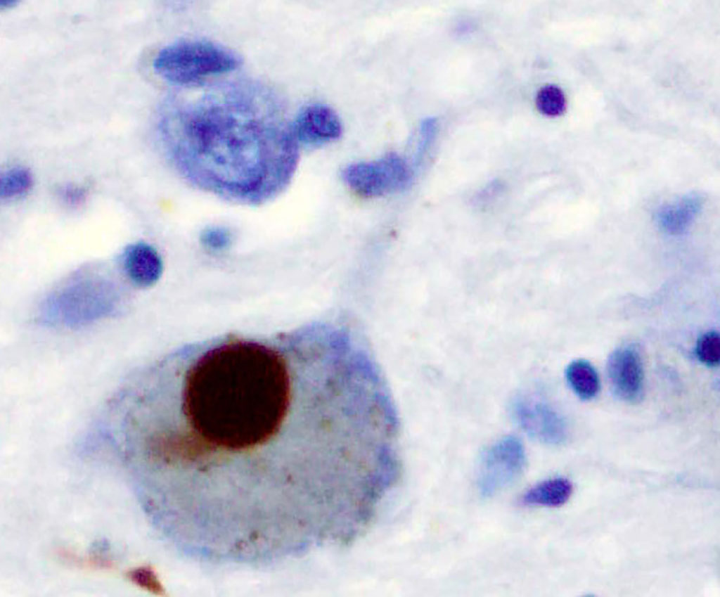 Image: Positive alpha-synuclein staining of a Lewy body from a patient who had Parkinson`s disease (Photo courtesy of Wikimedia Commons)
