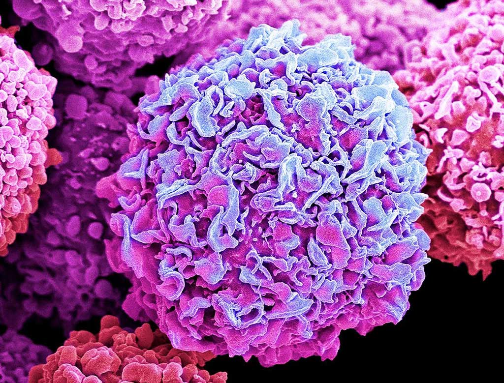 Image: A colored scanning electron micrograph (SEM) of a breast cancer cell (Photo courtesy of Case Western Reserve University School)