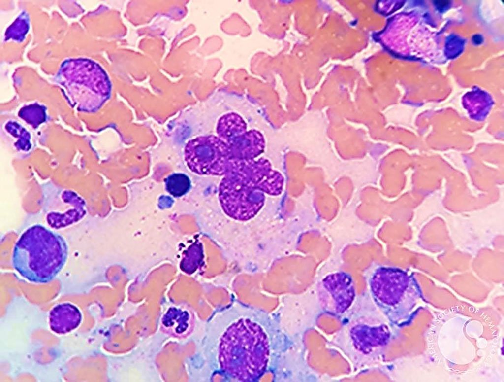 Image: Bone marrow aspirate from a patient with classical Hodgkin Lymphoma with large multinucleated Reed-Sternberg cells. “Hodgkin cells” are mononuclear while “Reed-Sternberg” cells are multinucleate forms (Photo courtesy of Nidia P. Zapata, MD and Espinoza-Zamora Ramiro)
