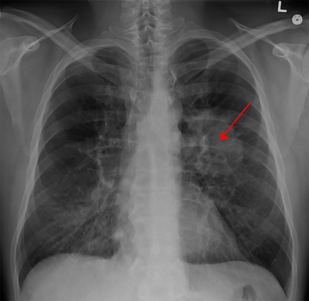 Image: A chest X-ray showing a tumor in the lung (marked by arrow) (Photo courtesy of Wikimedia Commons)