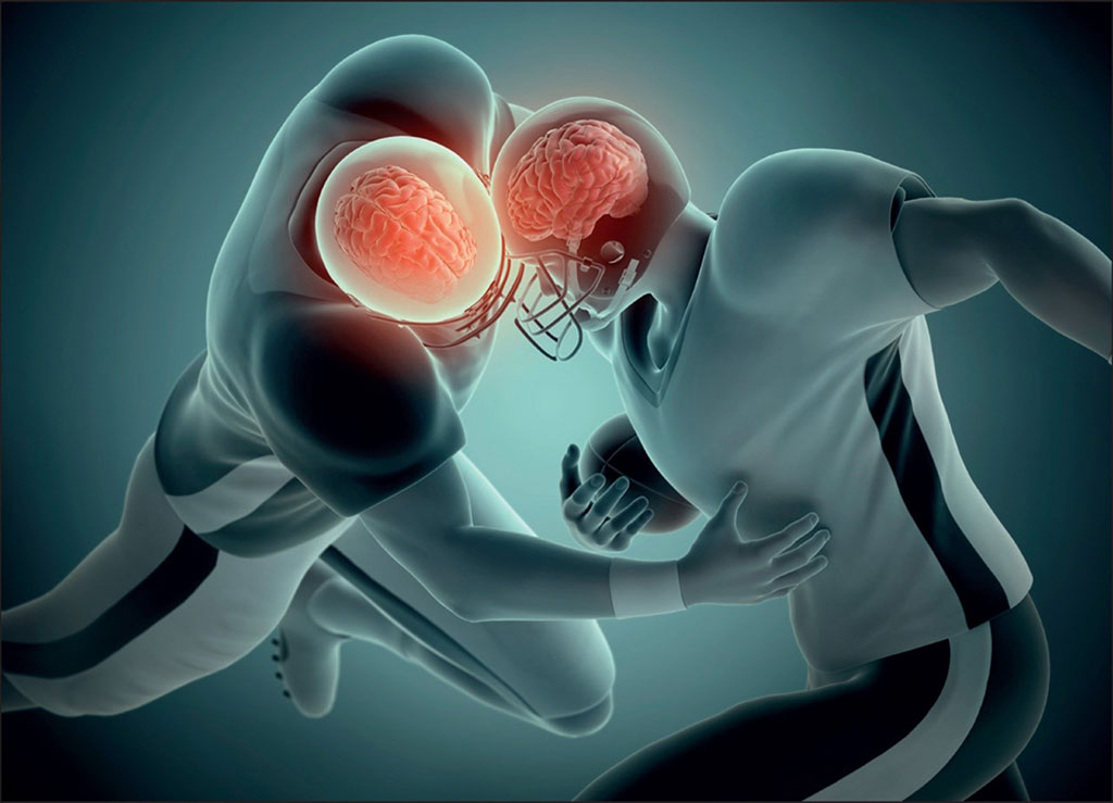 Image: Proteomic Noninvasive Biomarkers Discovered Associated with Sport-Related Concussions (Photo courtesy of The Lancet)