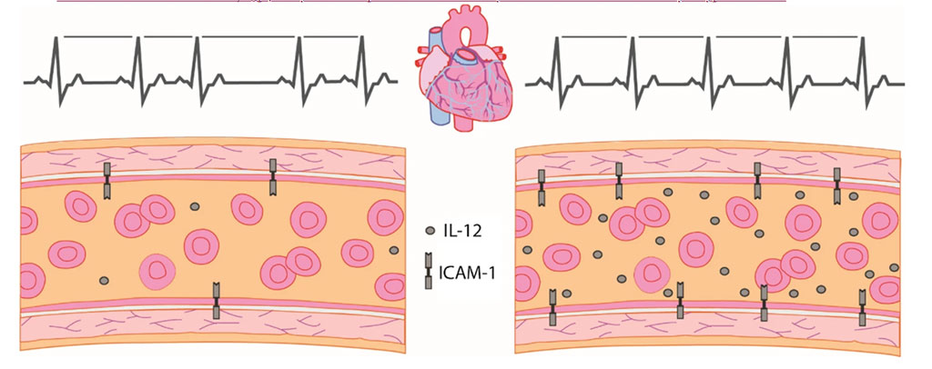 Image: Heart rate variability changes with levels of inflammatory serum markers. Left: normal levels of IL-12 and ICAM-1 associated with normal heart rate variability. Right: increased levels of IL-12 and ICAM-1 resulting in decreased heart rate variability. IL-12 is known to associate with arterial stiffness in healthy (Photo courtesy of BMC)