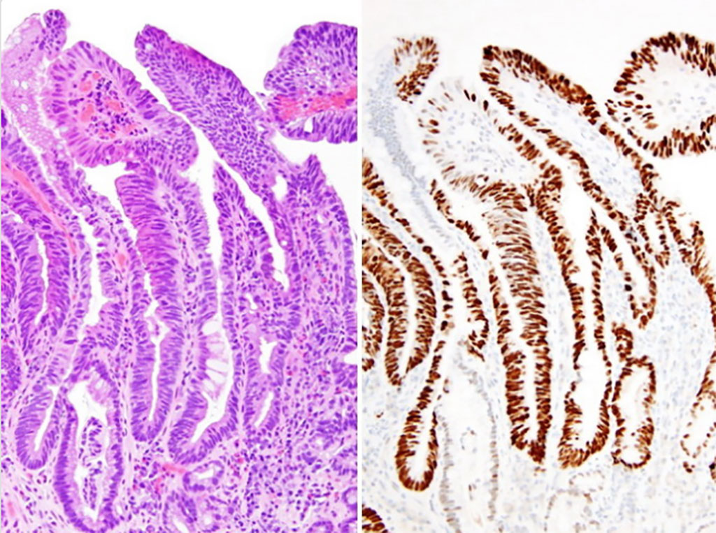 Image: Immunochemistry showing strong immunoreactivity for p53 in Barrett\'s esophagus with high-grade dysplasia (Photo courtesy of ARP Press (@ARP_Press)