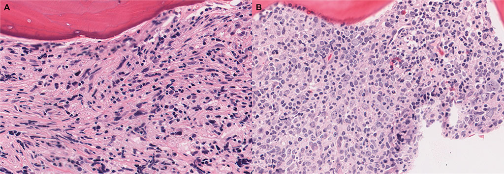 Image: Highly atypical cells in marrow examined for large cell transformation. Bone marrow core biopsies demonstrating (A) highly atypical cells including cells with prominent spindling of the nucleus and (B) cells with marked pleomorphism and/or multinucleation (Photo courtesy of Yale Medicine)
