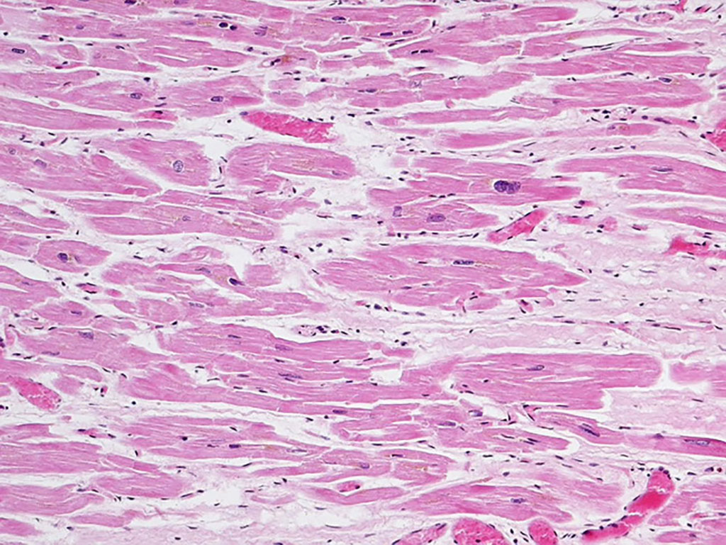 Image: Histopathology of dilated cardiomyopathy of unknown etiology in a 58 year female. The histologic findings in dilated cardiomyopathy are usually nonspecific. The image shows myocyte hypertrophy with enlarged hyperchromatic nuclei, mixed with myocyte atrophy and stretching. In addition, there is focal interstitial fibrosis (Photo courtesy of Dr. Dharam Ramnani)