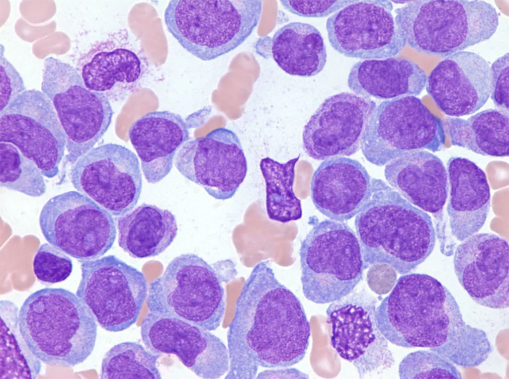 Image: Bone marrow of a pediatric patient with acute myeloid leukemia (Photo courtesy of St. Jude Children’s Research Hospital)
