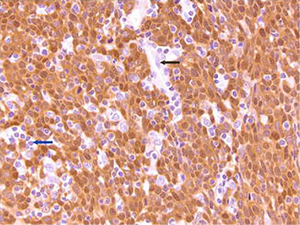 Image: Strong nuclear and cytoplasmic p16 staining of a section from an HPV+ oropharynx tumor. Lymphocytes (blue arrow) and endothelial cells (black arrow) are unstained (Photo courtesy of Jonathon McHugh, MD)