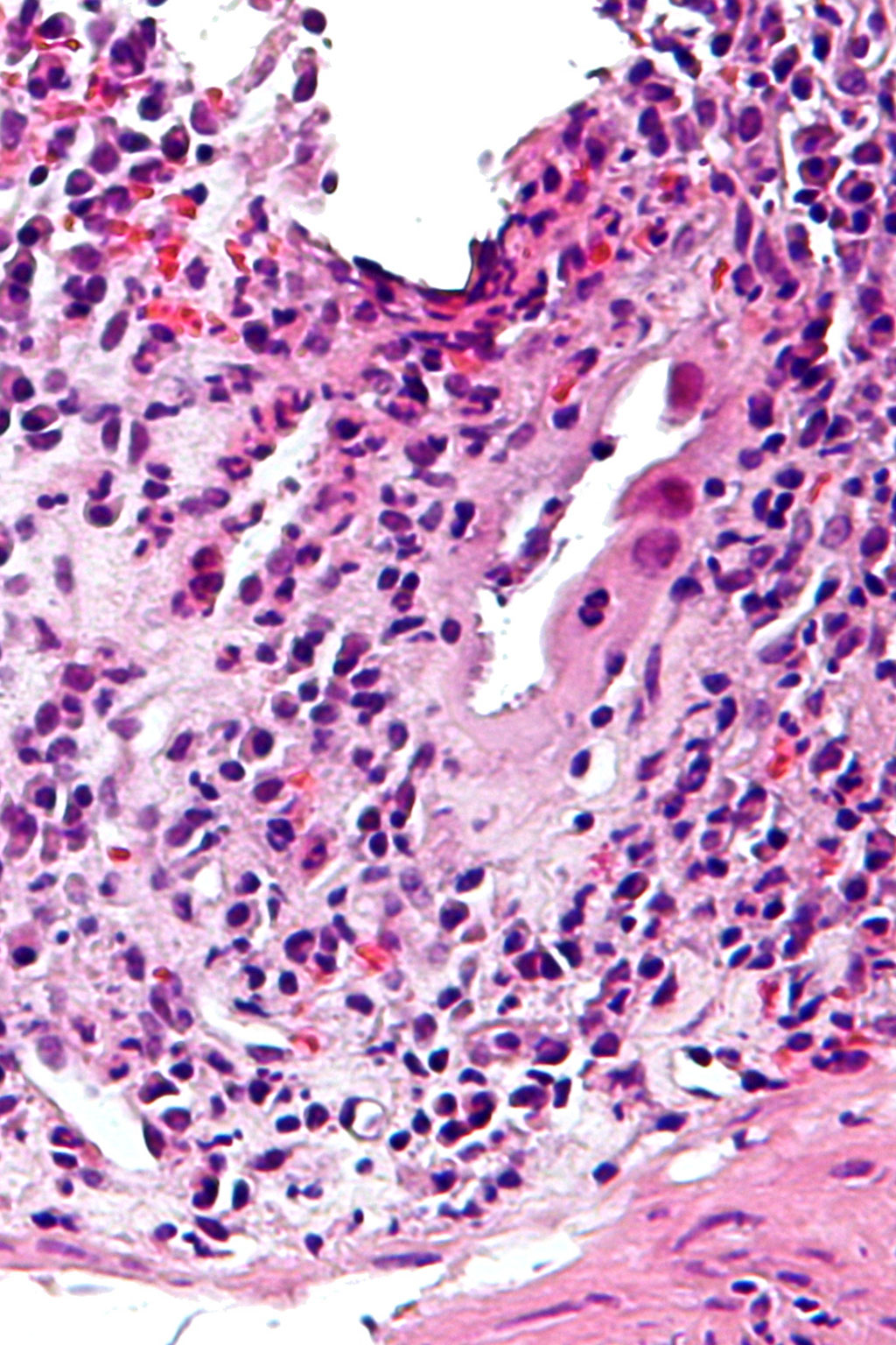Image: Photomicrograph of cytomegalovirus colitis (Photo courtesy of Nephron)