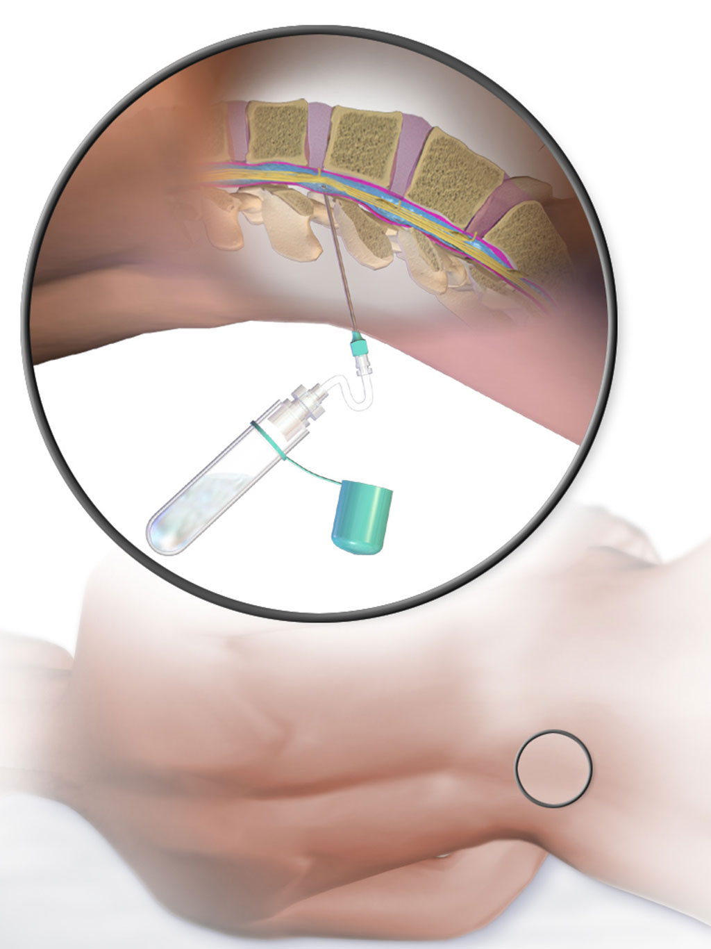 Image: Illustration depicting taking a lumbar puncture sample of CSF for liquid biopsy testing (Photo courtesy of Wikimedia Commons)