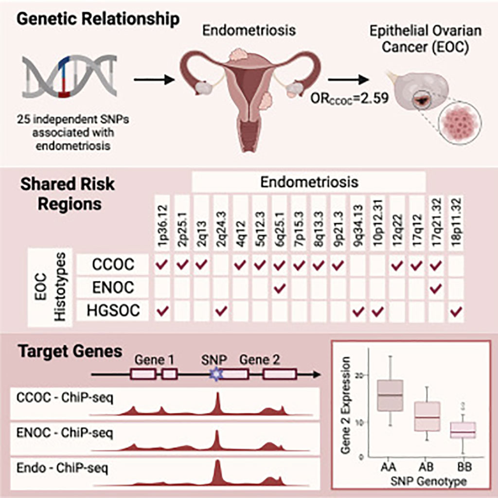 Image: Genetic Overlap Found for Ovarian Cancer Subtypes and Endometriosis (Photo courtesy of University of Queensland)