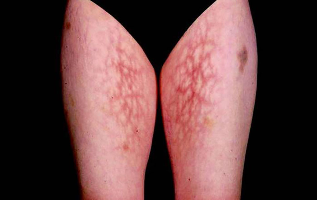 Image: Livedo Reticularis: this is one of the most important physical signs in Antiphospholipid syndrome (APS) and is felt by many physicians to be an additional risk factor for the risk of APS clinical events, over and above the presence of antiphospholipid antibody (Photo courtesy of Graham Hughes and Shirish Sangle)