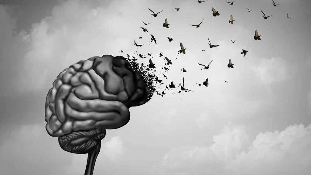 Image: Dementia, which can be caused by buildup of toxic molecules, cause brain injury, loss of memory and decline in intelligence (Photo courtesy of 123rf.com)