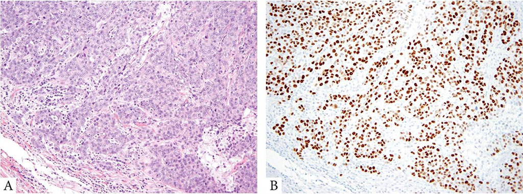 Image: Li-Fraumeni Syndrome: a) High-grade invasive ductal carcinoma with p53 overexpression; b) mutant pattern in a patient with a germline TP53 missense mutation (Photo courtesy of Brigham and Women’s Hospital)