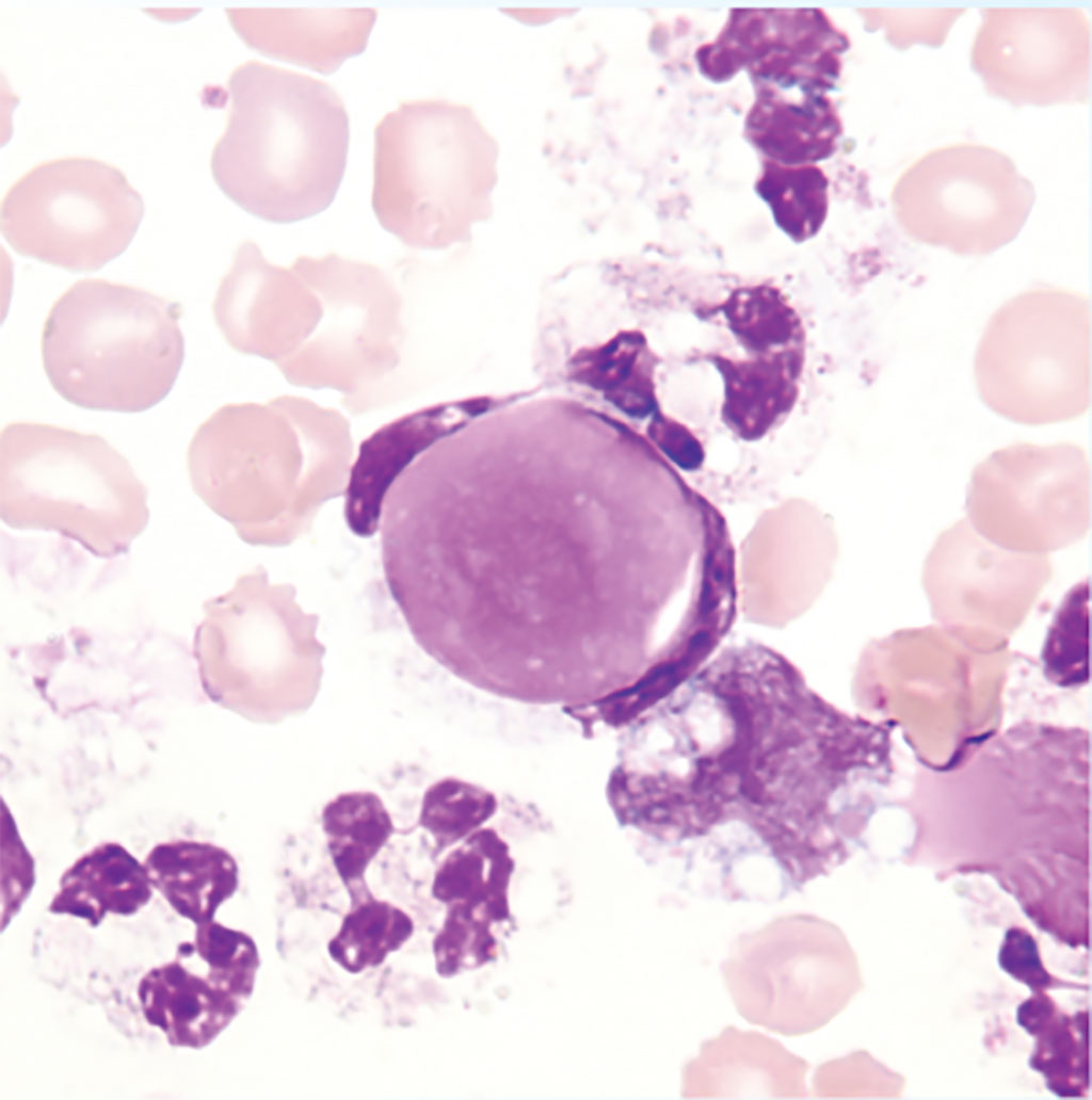 Image: Lupus Erythematosus (LE) Cells are neutrophils that have engulfed lymphocyte nuclei coated with and denatured by antibody to nucleoprotein and are found in systemic lupus erythematosus (Photo courtesy of Dr. Moustafa Abdou, MB, BCh)