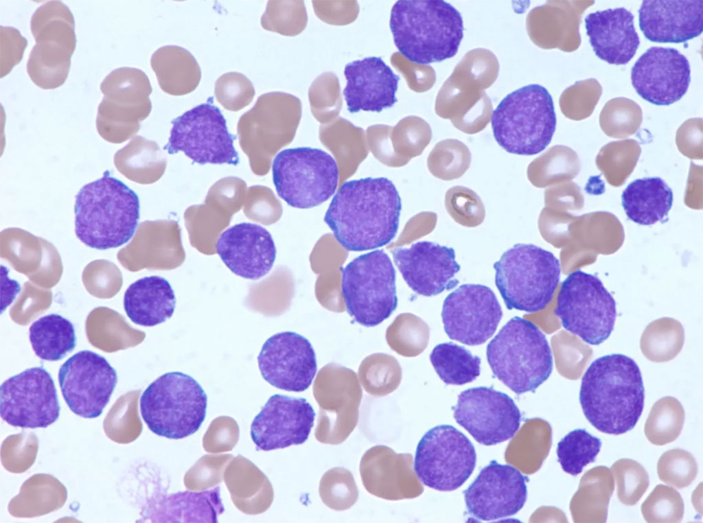 Image: Bone marrow aspirate of a pediatric patient with acute lymphoblastic leukemia (Photo courtesy of St. Jude Children’s Research Hospital)