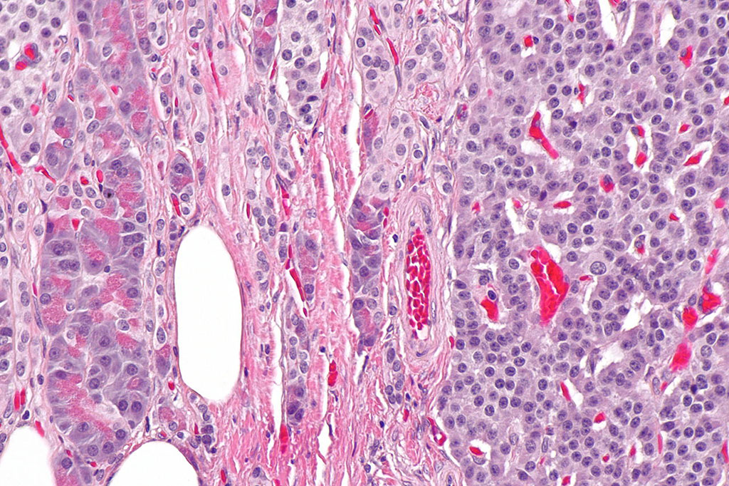 Image: Photomicrograph of histology of pancreatic neuroendocrine tumor (Photo courtesy of Nephron)