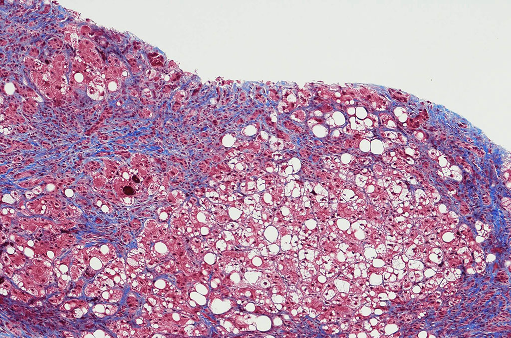 Image: Histopathology of metabolic associated fatty liver disease: serum thrombospondin-2 levels are associated with its severity (Photo courtesy of Endocrinology Advisor)