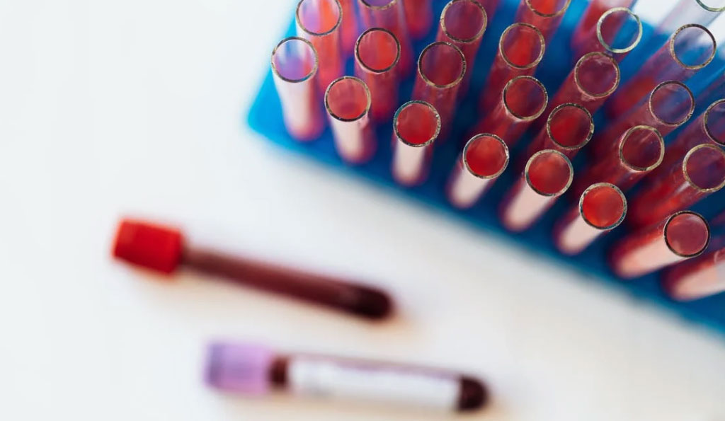 Image: Blood test to aid detection and evaluation of diseases associated with NETosis (Photo courtesy of Pexels)
