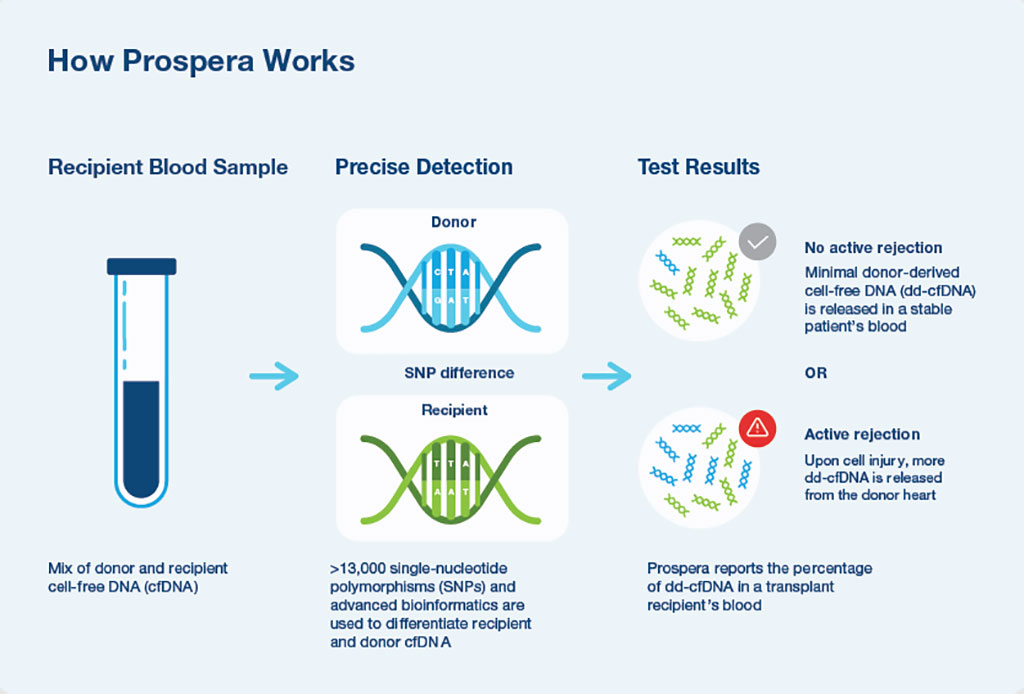 Image: The Prospera test is a novel donor-derived cell-free DNA assay for the detection of acute rejection in heart transplantation (Photo courtesy of Natera Inc)