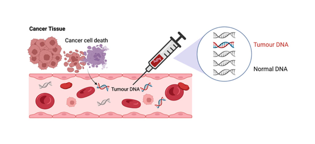 Image: After successful surgery to remove a bowel cancer a blood test can detect small fragments of cancer DNA in the blood in a small percentage of patients with stage II colon cancer, which indicate the presence of otherwise undetectable cancer cells (micrometastases) in the body, which will grow into metastatic cancers if not treated with chemotherapy (Photo courtesy of WEHI)