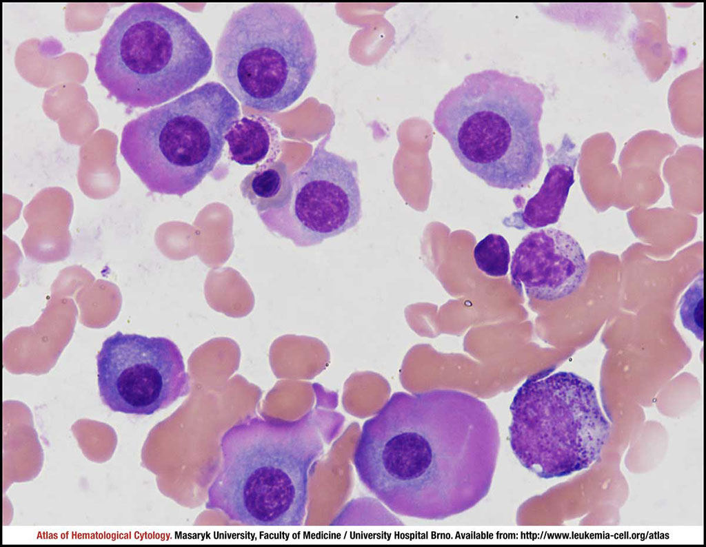 Image: Bone marrow aspirate from a patient with multiple myeloma: Myeloma plasma cells with prominent anisocytosis and relatively small nuclei. Note the marginal carminophilia of cytoplasm, which is rather marked in this case (Photo courtesy of Masaryk University)
