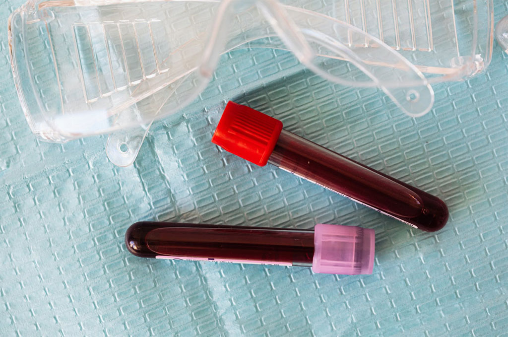 Image: New test could detect protein ‘fingerprints’ in the blood (Photo courtesy of Pexels)