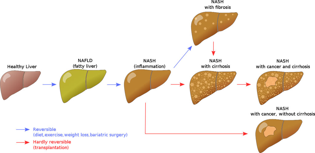 Image: Stages of progression of non-alcoholic fatty liver disease (Photo courtesy of Wikimedia Commons)