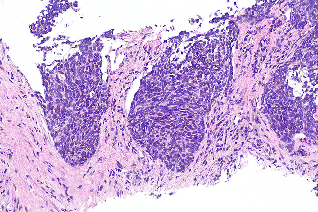 Image: Photomicrograph of histology stained preparation showing a non-small cell lung carcinoma (Photo courtesy of Wikipedia/Librepath)