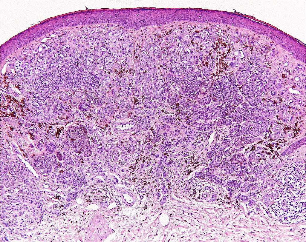 Image: Photo micrograph of Histopathology of Malignant Melanoma (Photo courtesy of DiseaeseShows)