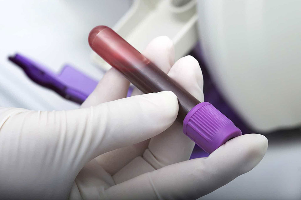 Image: A simple blood test for glioblastomas could mean earlier diagnosis (Photo courtesy of University of Bristol)