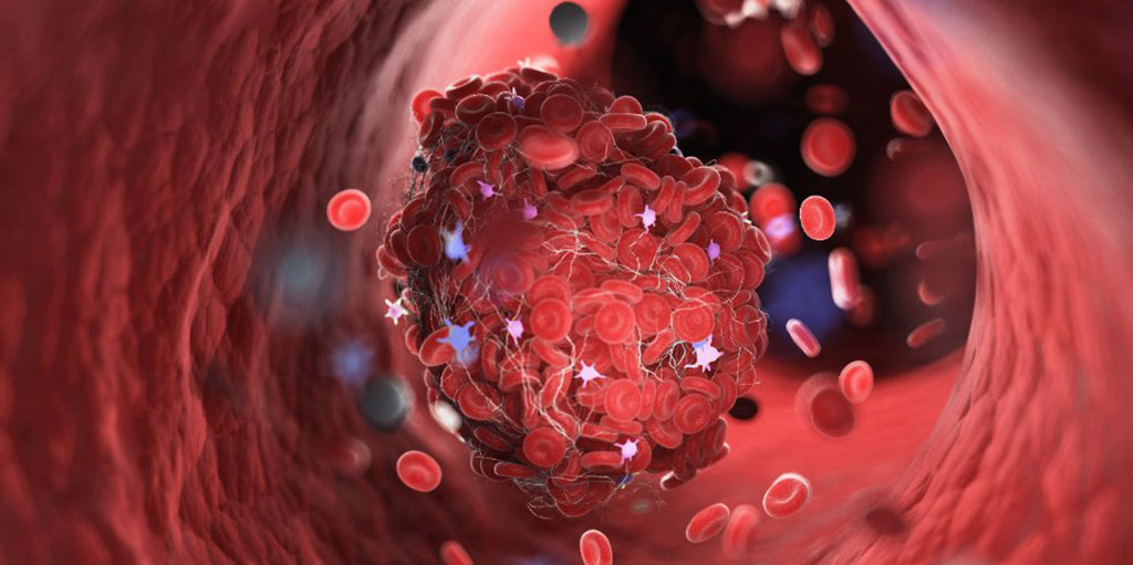 Image: Three-dimensional rendered illustration of a blood clot (Photo courtesy of 123rf.com)