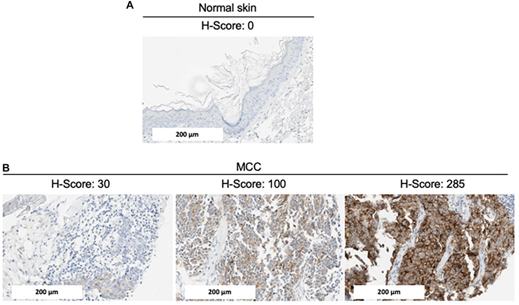 Image: Representative GPC3 expression by IHC: Immunohistochemical staining of (A) normal skin and (B) MCC tumors for GPC3 expression. Representative images with different levels of GPC3 (and H-scores) are shown (Photo courtesy of University Hospital of Tours)