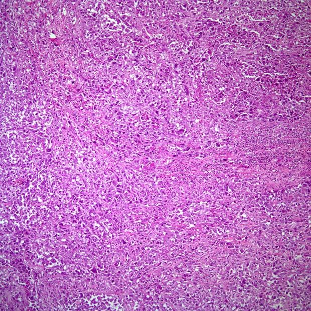 Image: Histology of anaplastic thyroid carcinoma that features cellular pleomorphism, large atypical cells, myxoid degeneration, and bizarre giant cells (Photo courtesy of Cesar A. Moran, MD).
