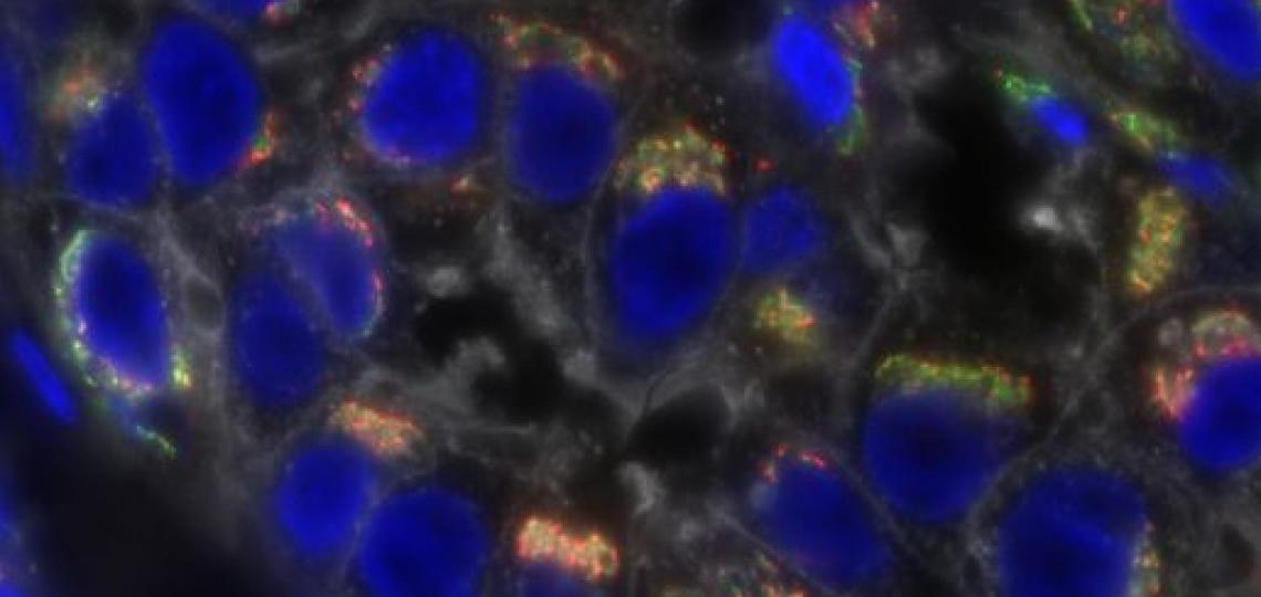 Image: Micrograph of triple-negative breast cancer cells (Credit: Baylor Medical College)