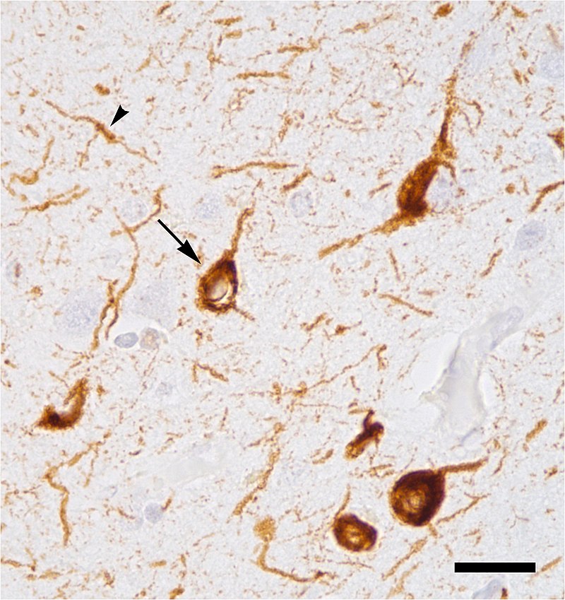 Abnormal accumulation of tau protein in neuronal cell bodies (arrow) and neuronal extensions (arrowhead) in the neocortex of a patient who had died with Alzheimer\'s disease. (Credit: Wikimedia Commons)
