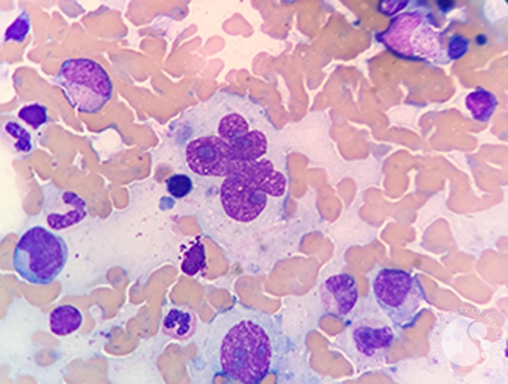 Image: Bone marrow aspirate from a patient with Classic Hodgkin lymphoma showing large multinucleated Reed-Sternberg cells. “Hodgkin cells” are mononuclear while “Reed-Sternberg” cells are multinucleate forms (Photo courtesy of Nidia P. Zapata, MD and Espinoza-Zamora Ramiro).