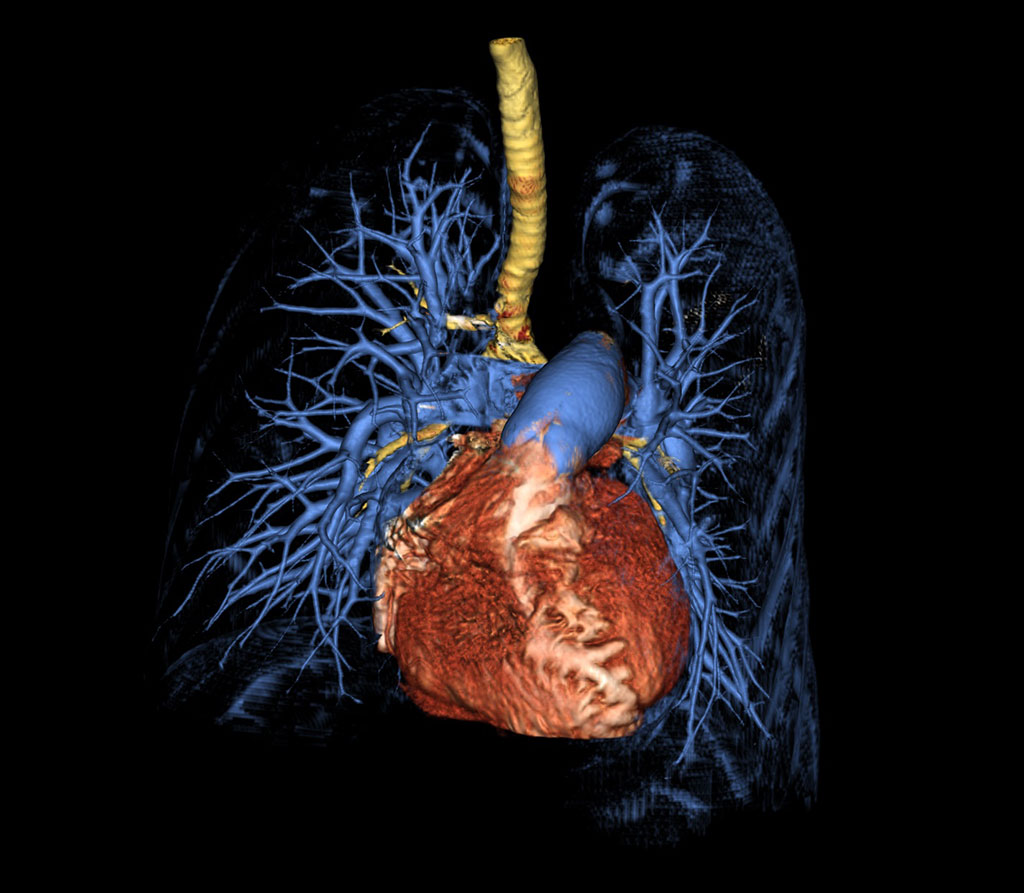 Image: CT 3D surface rendering of the lungs and heart from a patient with pulmonary arterial hypertension (Photo courtesy of NIH)