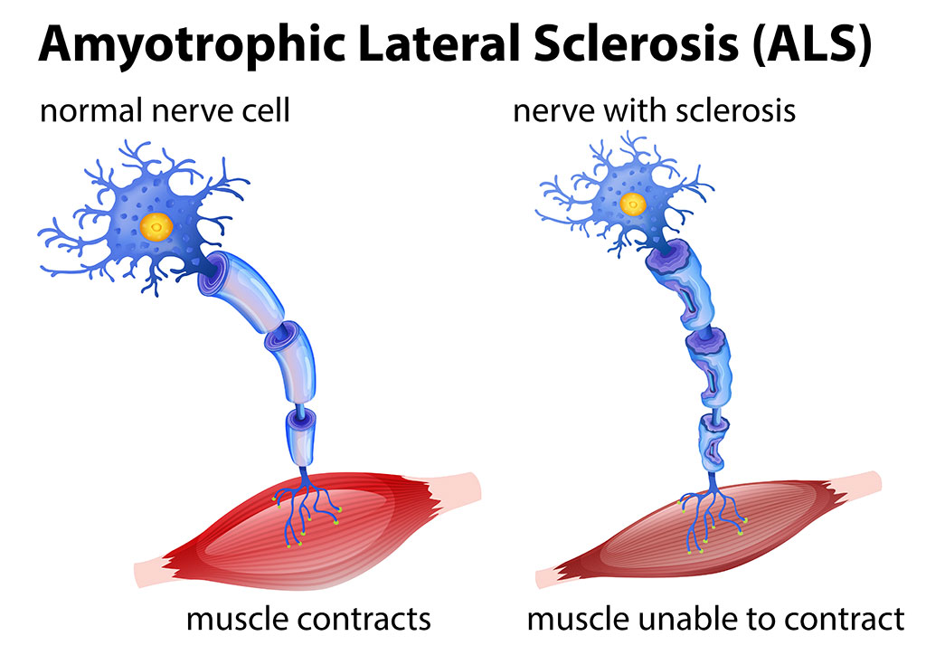 Image: Artist’s conception of amyotrophic lateral sclerosis (ALS) (Photo courtesy of www.123rf.com)