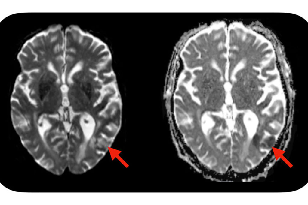 Image: A simple blood test - administered before CAR-T cell treatment is initiated - may identify which patients are predisposed to developing neurotoxic side effects after CAR-T cell therapy. Severe side effects can include seizures, brain swelling, and strokes. Evidence of a stroke (red arrows) is seen on this MRI scan of the brain of a patient who developed neurotoxic side effects after CAR-T cell therapy (Photo courtesy of Dr. Omar Butt, Washington University School of Medicine)