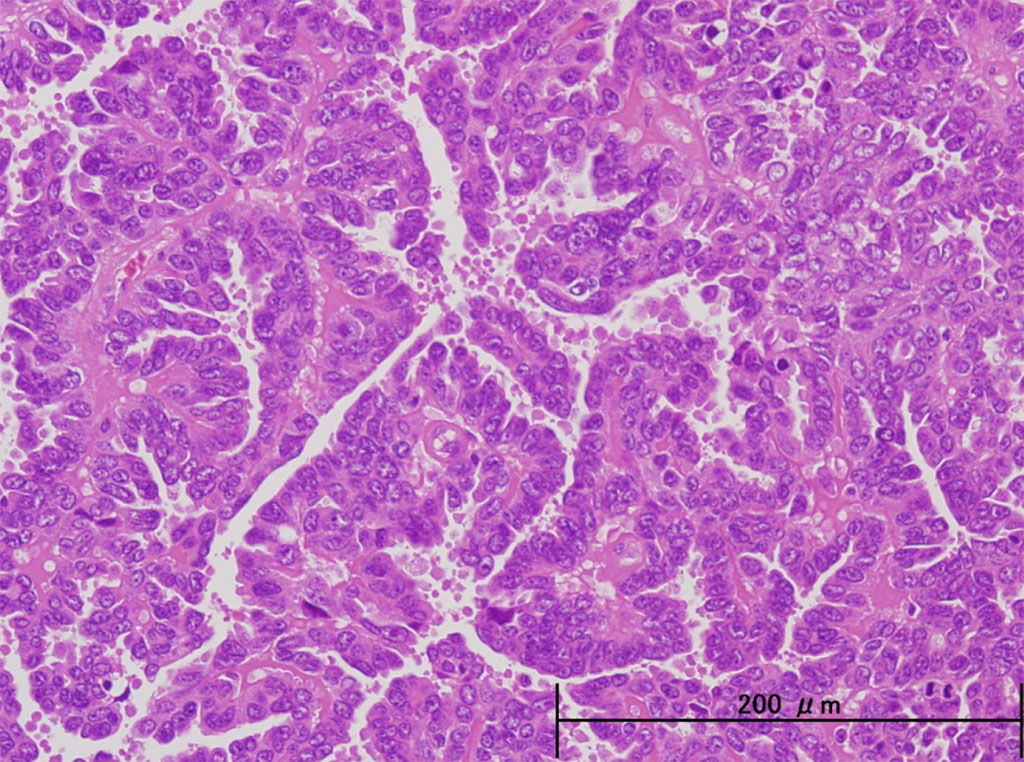 Image: Histopathology of endometrial serous carcinoma which is characterized by high-grade cytological atypia in cells that do not share a common apical border. A papillary architecture is common (Photo courtesy of Shimane University School of Medicine)