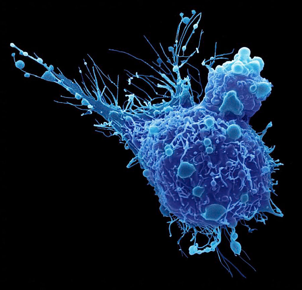 Image: Colored scanning electron micrograph (SEM) of a bladder cancer cell. Its several long cytoplasmic projections may enable it to be motile (Photo courtesy of Steve Gschmeissner)