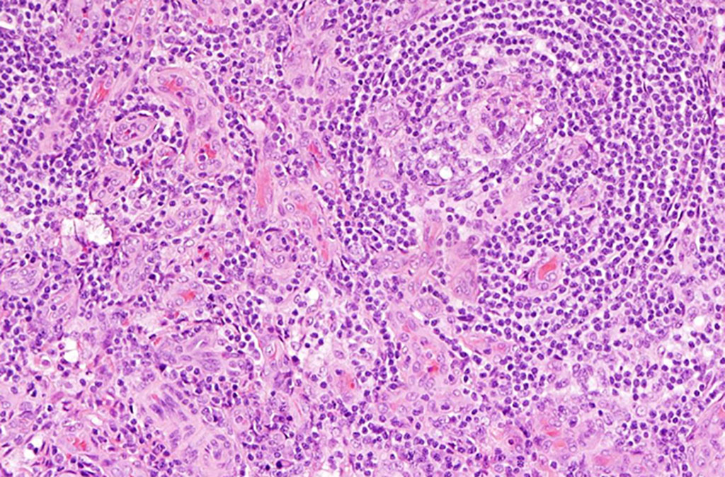 Image: Histopathology of lymph node tissue from a person with idiopathic multicentric Castleman disease. Increased number of blood vessels and smaller germinal centers where immune cells mature in the lymph node, which are two of the pathology features needed to make the diagnosis (Photo courtesy of David Fajgenbaum, MD)