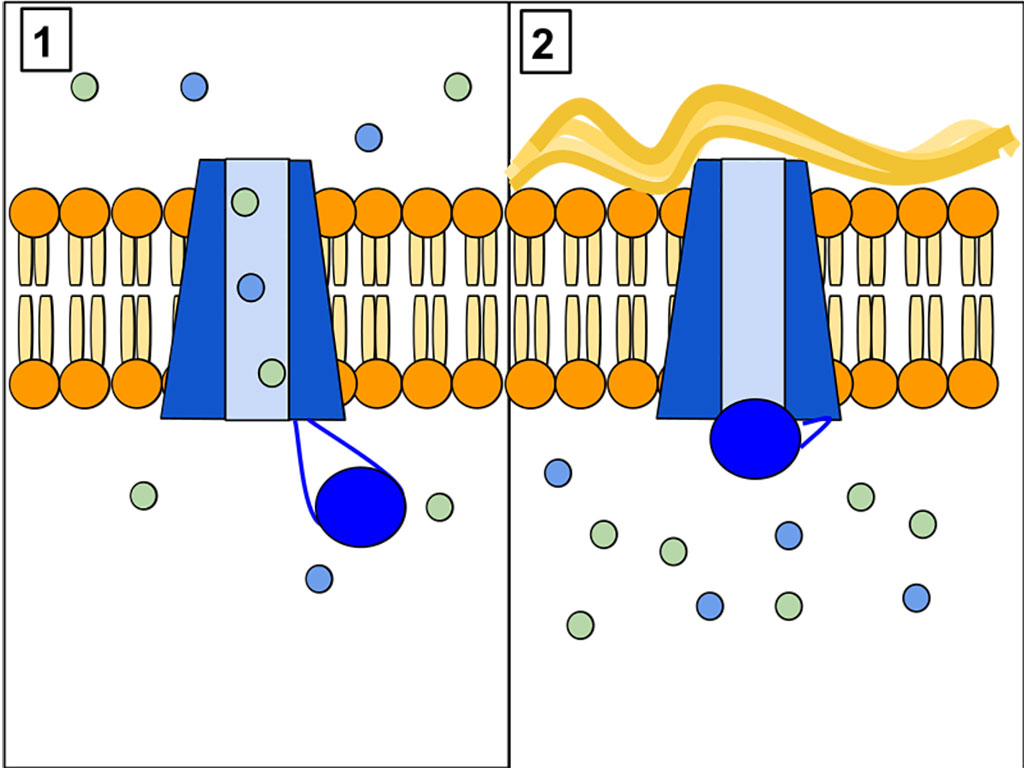 Image: The CFTR protein is a channel protein that controls the flow of H2O and Cl- ions into and out of cells inside the lungs. When the CFTR protein is working correctly, as shown in Panel 1, ions freely flow in and out of the cells. However, when the CFTR protein is malfunctioning as in Panel 2, these ions cannot flow out of the cell due to a blocked channel. This causes cystic fibrosis, characterized by the buildup of thick mucus in the lungs (Photo courtesy of Wikimedia Commons)