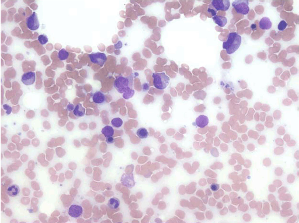 Image: Bone marrow aspirate from a patient with systemic lupus erythematosus showing trilineage dysplastic changes thought to represent myelodysplastic changes (Photo courtesy of Dr. Kingsuk Mukherji)