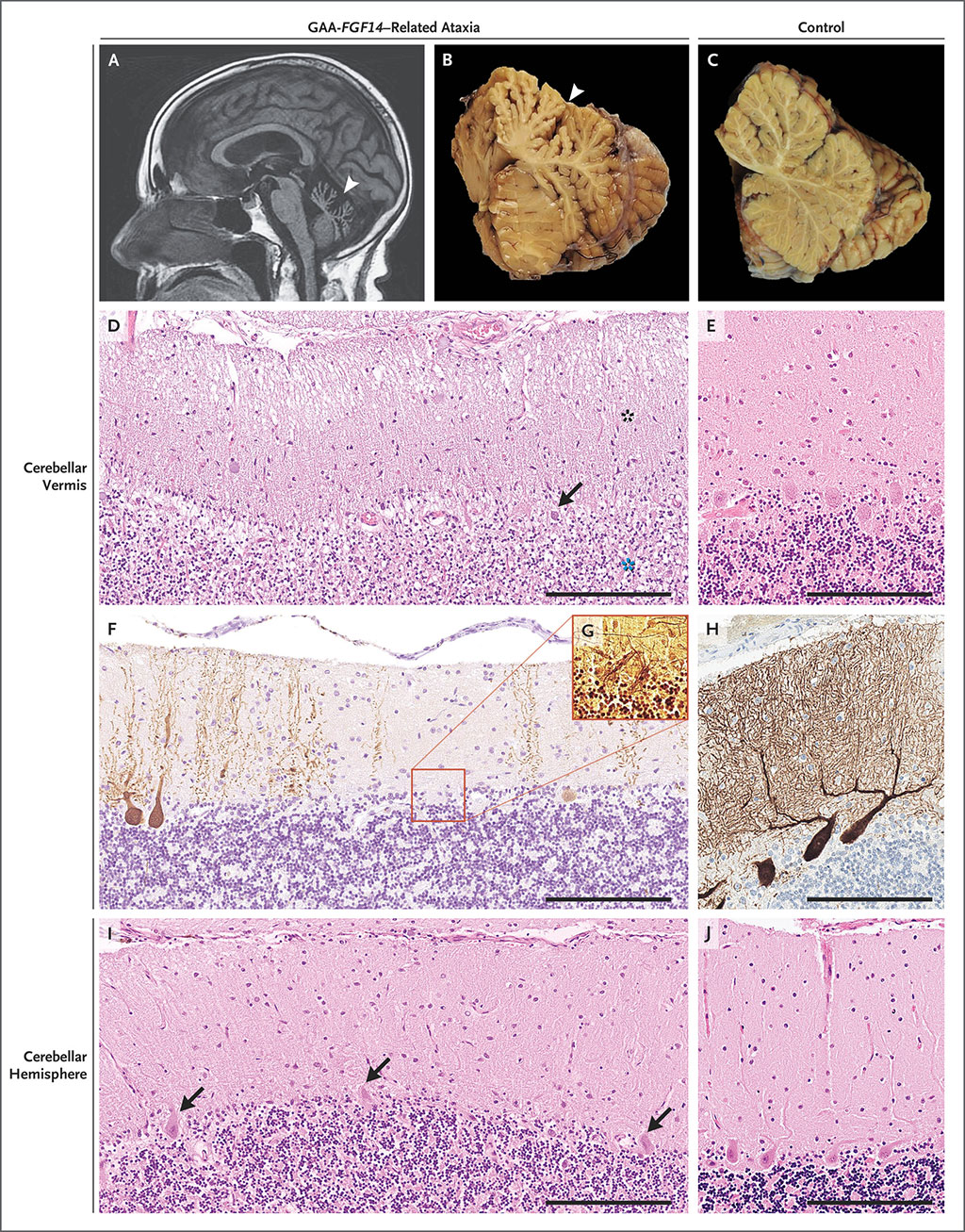 Image: Imaging and Neuropathological Findings in Patients with GAA-FGF14–Related Ataxia (Photo courtesy of McGill University)