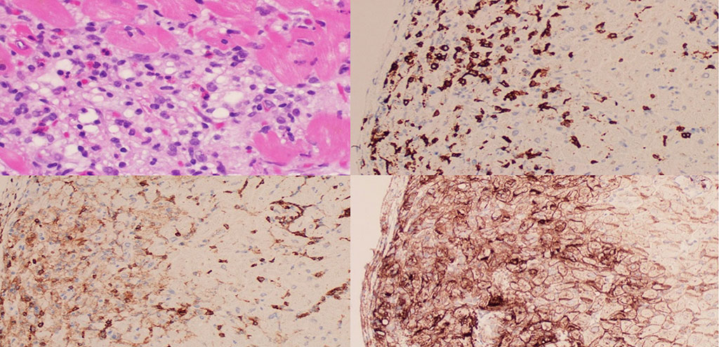 Image: Histopathological characteristics of immune checkpoint inhibitor–associated myocarditis (Photo courtesy of The University of Texas MD Anderson Cancer Center)