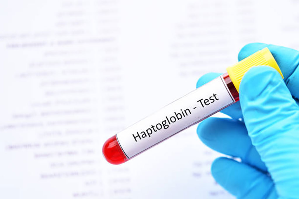 Image: Haptoglobin 1 allele predicts higher serum haptoglobin concentration and lower multiorgan failure risk in sickle cell disease (Photo courtesy of Dreamstime)