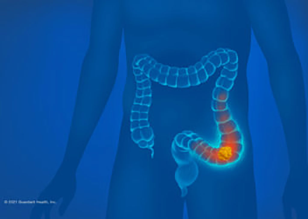 Image: The test demonstrated 83% sensitivity for the detection of colorectal cancer with specificity of 90% (Photo courtesy of Guardant Health)